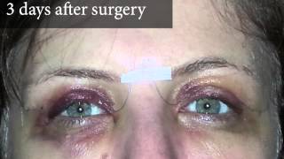 Upper Eyelid Surgery  After Photos 3 Days Post Surgery  8 West Clinic in Vancouver BC [upl. by Esbensen975]