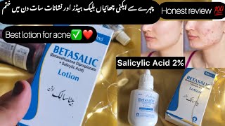 Betasalic Lotion ReviewGet Rid Of Acne White and black Heads [upl. by Ansev]