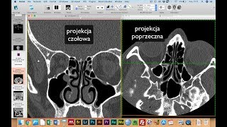 RTG i TK  przykłady badań z różnicami i możliwościami obu metod [upl. by Arakat]