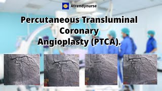 cathlab angiogram coronary angioplasty Percutaneous Transluminal Coronary Angioplasty PTCA [upl. by Yrolg]