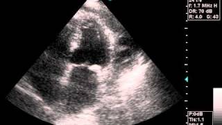 echocardiography pericardial effusionavi [upl. by Duax]