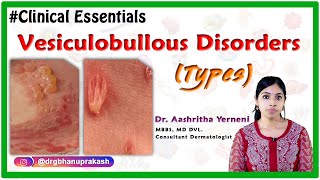 Vesiculobullous disorders Types Clinical essentials DrAashritha yerneni [upl. by Alebasi]