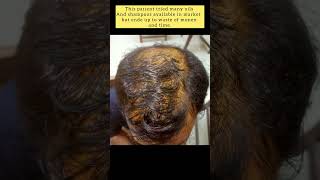 Androgenic alopecia can be reversed alopeciahairtransformationshortshairlosstipsdermatologist [upl. by Clercq]