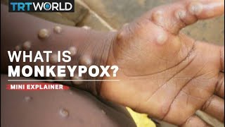 What is monkeypox [upl. by Oiliruam]