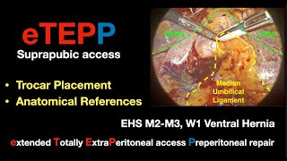 Preperitoneal eTEPP for M2M3 W1 R0 D2 Ventral hernia and Diastasis on female Dr Valenzuela [upl. by Soisanahta699]