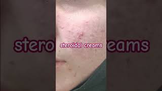 Whitening Cream Side Effects l Red Face [upl. by Nette]