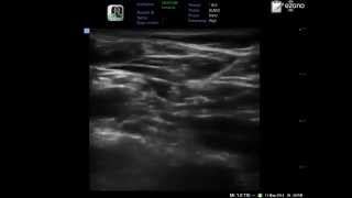 ultrasound guided supraclavicular brachial plexus block in one minute only [upl. by Irehc]