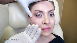 Beverly Hills Tear Trough Filler  Los Angeles Adding Periocular Volume  Dr Kami Parsa [upl. by Lafleur994]