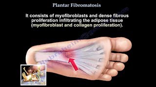 Plantar Fibromatosis  Everything You Need To Know  Dr Nabil Ebraheim [upl. by Alf]