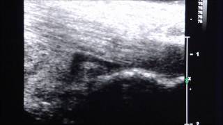 UltrasoundGuided Injection of Retrocalcaneal Bursitis [upl. by Nnylharas]