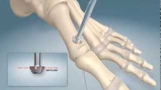 1st MTPJ arthrodesis procedure [upl. by Armstrong992]