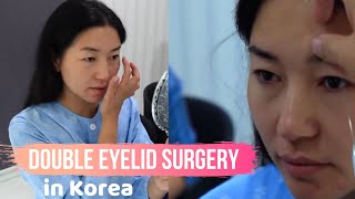 Incisional Double Eyelid Surgery in Korea [upl. by Eitra]