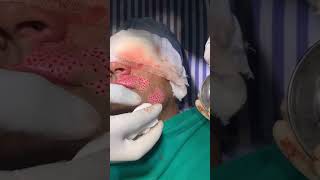 Vitiligo Surgery 👩🏻‍💼 Happy Patient Review amp Story  Skinaa Clinic Viral shorts [upl. by Sneve]