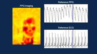 Camera based PPG Imaging [upl. by Oiruam]