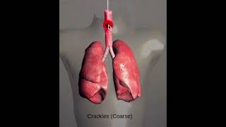 Lung SoundsNormal and AbnormalCracklesWheeze StridorRonchiOn Respiratory Auscultation Sound [upl. by Ybsorc]