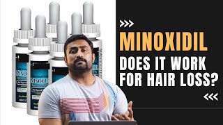 MINOXIDIL  DOES IT WORK FOR HAIR LOSS [upl. by Iclehc]