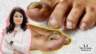 👣Tutorial on How to Care amp Treat a Detached Big Toenail with a Pedicure👣 [upl. by Clements]