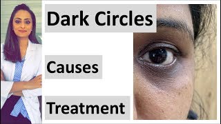 How to get rid of Dark circles  causes amp treatment  creams peels lasers fillers home remedies [upl. by Holladay870]