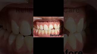 Broken tooth Toote daant ko kaise thk karein  drnidha drteeth dentalclinic brokenteeth cavity [upl. by Georgi]