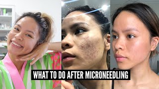 12 Important Microneedling Aftercare Tips [upl. by Neersan]