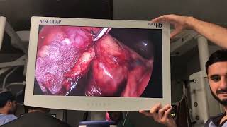 Laparoscopic Right Radical Nephrectomy for Rt Renal mass unedited speed 35 [upl. by Eimmat]