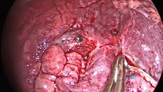 Uniportal VATS RML lobectomy [upl. by Latoya746]