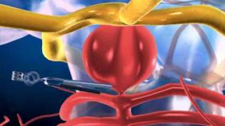 Aneurysm in the Brain and Clipping  3D medical animation  ABP © [upl. by Anrym]