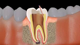 Root canal treatment RCT Procedure animation [upl. by Sined]