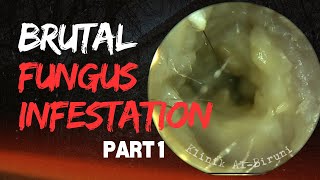 BRUTAL Fungus Infestation Due To Physician Mistake  PART 1 [upl. by Andromache]