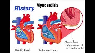 Myocarditis History mrcpch Clinical [upl. by Batsheva]