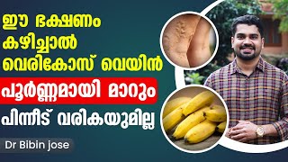 ഈ ഭക്ഷണങ്ങൾ കഴിച്ചു വെരികോസ് വെയ്ൻ പൂർണമായി മാറ്റം Vericose Treatment in Malayalam Dr Bibin Jose [upl. by Ojok103]