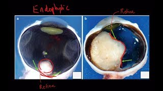 High Yield Topic Retinoblastoma  A Complete Review [upl. by Gareri]