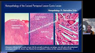 Cystic Lesion of Endodontic Origin  17 Years After  Prof Latifa Berrezouga [upl. by Cosetta706]