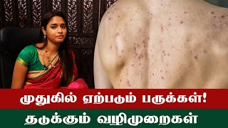 Proper Treatment For Back Acne  முதுகில் உள்ள பருக்களுக்கு நீங்கள் செய்யவேண்டியது செய்யக்கூடாதது [upl. by Oicanata]