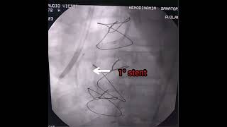 Angioplastia a Coronaria derecha En paciente con bypass [upl. by Kalikow]