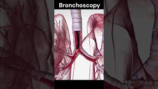 Bronchoscopy [upl. by Eelinej348]