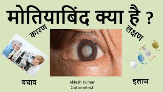 Cataract  Cataract Symptoms  Cataract Causes  Cataract Treatment  cataract surgery  Hindi Me [upl. by Teik]