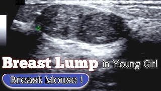 Ultrasound Young Girl Breast  Fibroadenomas  Breast Mouse [upl. by Aisatan]