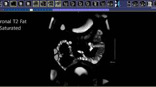 How to read an MR Enterography [upl. by Eniwtna]