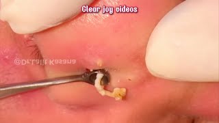 Big Cystic Acne Blackheads Extraction Blackheads amp Milia Whiteheads Removal Pimple Popping [upl. by Kreindler]