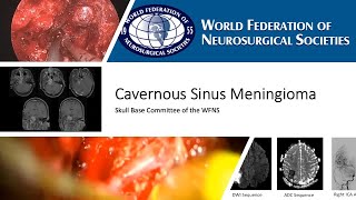 Cavernous Sinus Meningiomas WFNS Skull Base Committee Round Table Oct 2023 [upl. by Alekin]