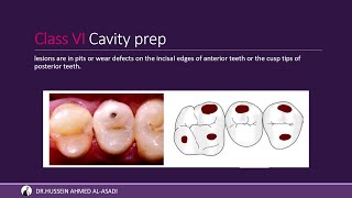 Dental Caries amp Class Of Cavity شرح التسوس ونوع الكلاسات [upl. by Shelden]