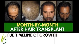 When Will Hair Grow after My Hair Transplant  Darling Buds [upl. by Pillihp]