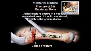 Metatarsal Fractures  Everything You Need To Know  Dr Nabil Ebraheim [upl. by Werdna]