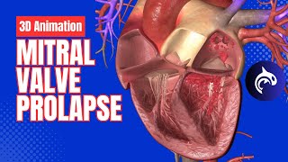 Mitral Valve Prolapse  3D Animation [upl. by Sacken]