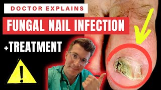 How to recognise diagnose amp treat FUNGAL NAIL INFECTION Onychomycosis  Doctor ODonovan explains [upl. by Eimorej]