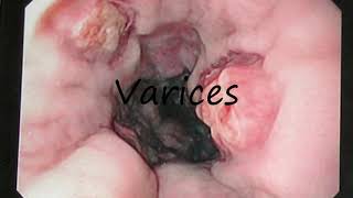 How to Pronounce Varices [upl. by Aderf]