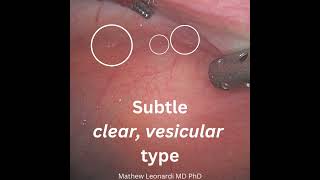 Can you spot the superficial endometriosis ultrasound surgery endometriosisdiagnosis [upl. by Ralyt]