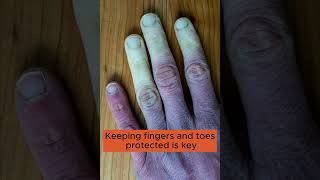 Would you recognise Raynauds Syndrome symptoms [upl. by Katharyn]