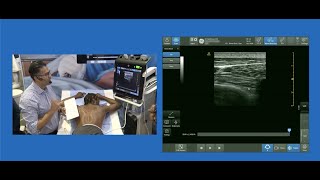 Transverse InPlane Approach to Thoracic Paravertebral Block [upl. by Muir]